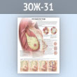 Плакат «Что такое рак груди?» (ЗОЖ-31, пластик 2 мм, А2, 1 лист)